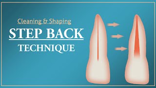 Step Back Technique  Root Canal Treatment [upl. by Ralip631]