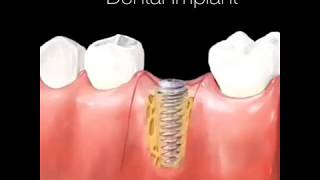 Dental Implant Procedure [upl. by Goldia369]