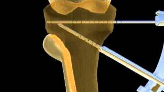 Intervento di osteotomia [upl. by Hoopen]