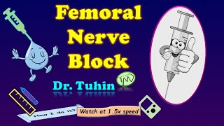 PNS Guided Femoral Nerve Block  FNB  Peripheral Nerve Stimulator  DrTuhinM [upl. by Ardnasirhc]