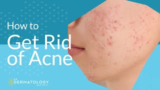 Acne Treatment  Explained by Dermatologist [upl. by Ydnahs]