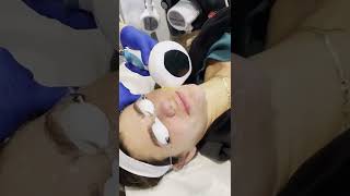 Lumecca IPL Treatment [upl. by Abekam218]