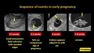 Early Pregnancy Failure A simplified Ultrasound Approach [upl. by Ahsimac833]