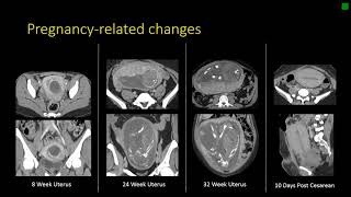 Gynecologic Radiology Anatomy [upl. by Omari]