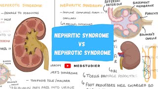 What is the difference between Nephritic and Nephrotic syndrome  MedStudier [upl. by Sergio]