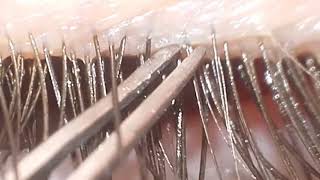 Eyelash Mites Demodex [upl. by Anig100]