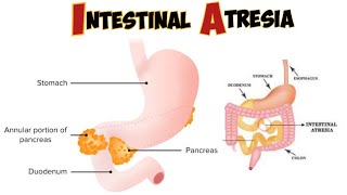 Intestinal atresia amp stenosis [upl. by Olra]