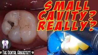 Molar Tooth Caries Removal and Restoration Pasta sa Bagang42 [upl. by Ahsienor]