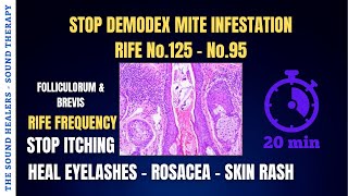 DEMODEX ➤ Stop Itching ➤ Mite Infestation ➤ Heal Eyelashes ➤ Dermatitis ➤ Skin Rash ➤ Sound Therapy [upl. by Einnhoj487]