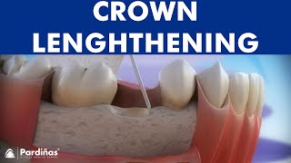 Dental crown lengthening © [upl. by Alleunamme595]