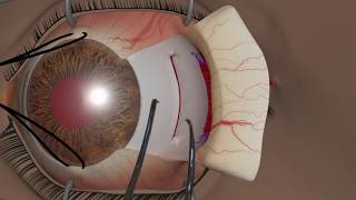 Strabismus surgery Recession [upl. by Irami449]