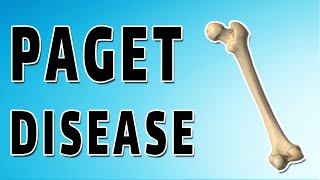 Pagets Disease [upl. by Zilber]