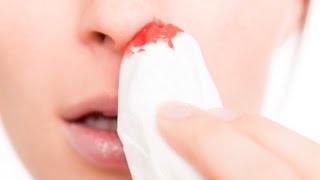 My Nose Bleeds Every Day – Should I Be Worried [upl. by Quin]