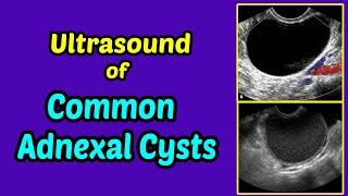 Ultrasound of Common Adnexal Cysts [upl. by Keary127]