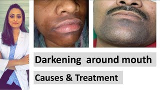 Darkening around mouth  causes  treatment  Dermatologist  Dr Aanchal Panth [upl. by Forsta]