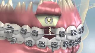 Impacted Tooth Exposure amp Uncovering For Orthodontics [upl. by Sand]