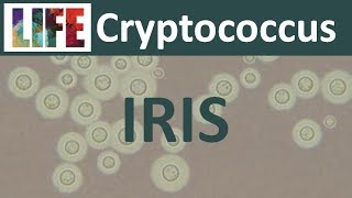 Cryptococcal IRIS [upl. by Searcy]