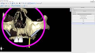 Guided Zygomatic Implants [upl. by Wyly973]