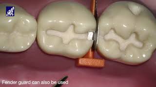 Cavity Preparation Series Class II [upl. by Masson293]