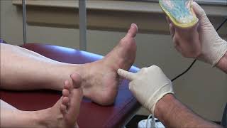 Surgery for plantar fasciitis [upl. by Airda]