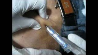 How To Give Goserelin Injection By Subcutaneous Mode [upl. by Nagaet]