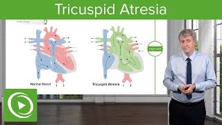 Tricuspid Atresia – Pediatric Cardiology  Lecturio [upl. by Theressa]