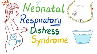 Neonatal Respiratory Distress Syndrome NRDS  Pediatrics  Pulmonology [upl. by Gerardo]