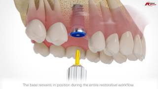 On1 restorative concept  Nobel Biocare [upl. by Phelia]