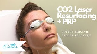 CO2 Laser Skin Resurfacing  PRP  Better Results and Faster Recovery [upl. by Azmuh]