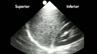 Anleitung Ultraschallerkennung von Pleuraflüssigkeit [upl. by Anse]