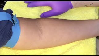 Tips For Locating Difficult Veins [upl. by Montague367]