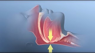 Obstructive Sleep Apnea Syndrome OSAS  Causes and treatment [upl. by Trust840]