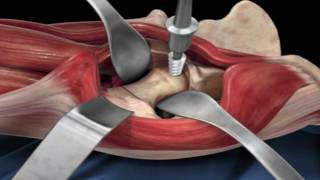 Direct Anterior Approach Hip Replacement [upl. by Nonnaehr499]