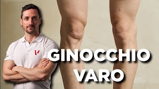 Ginocchio varo esercizi correttivi [upl. by Idnib]